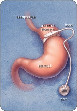 250-banding.jpg Laparoscopic Adjustable Gastric Banding