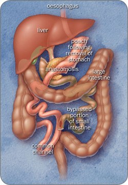 Biliopancreatic Diversion and Duodenal Switch