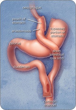 Laparoscopic Roux-en-Y Gastric Bypass