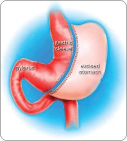 250-sleeve.jpg Laparoscopic Roux-en-Y Gastric Bypass