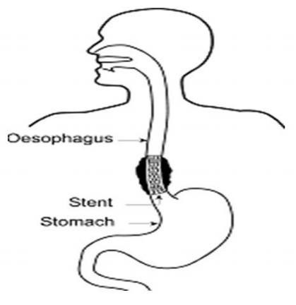 oesophagus/gullet