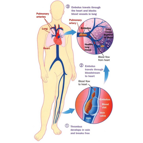 Diagram reproduced with permission of the Thrombosis Research Institute, London UK (2008)